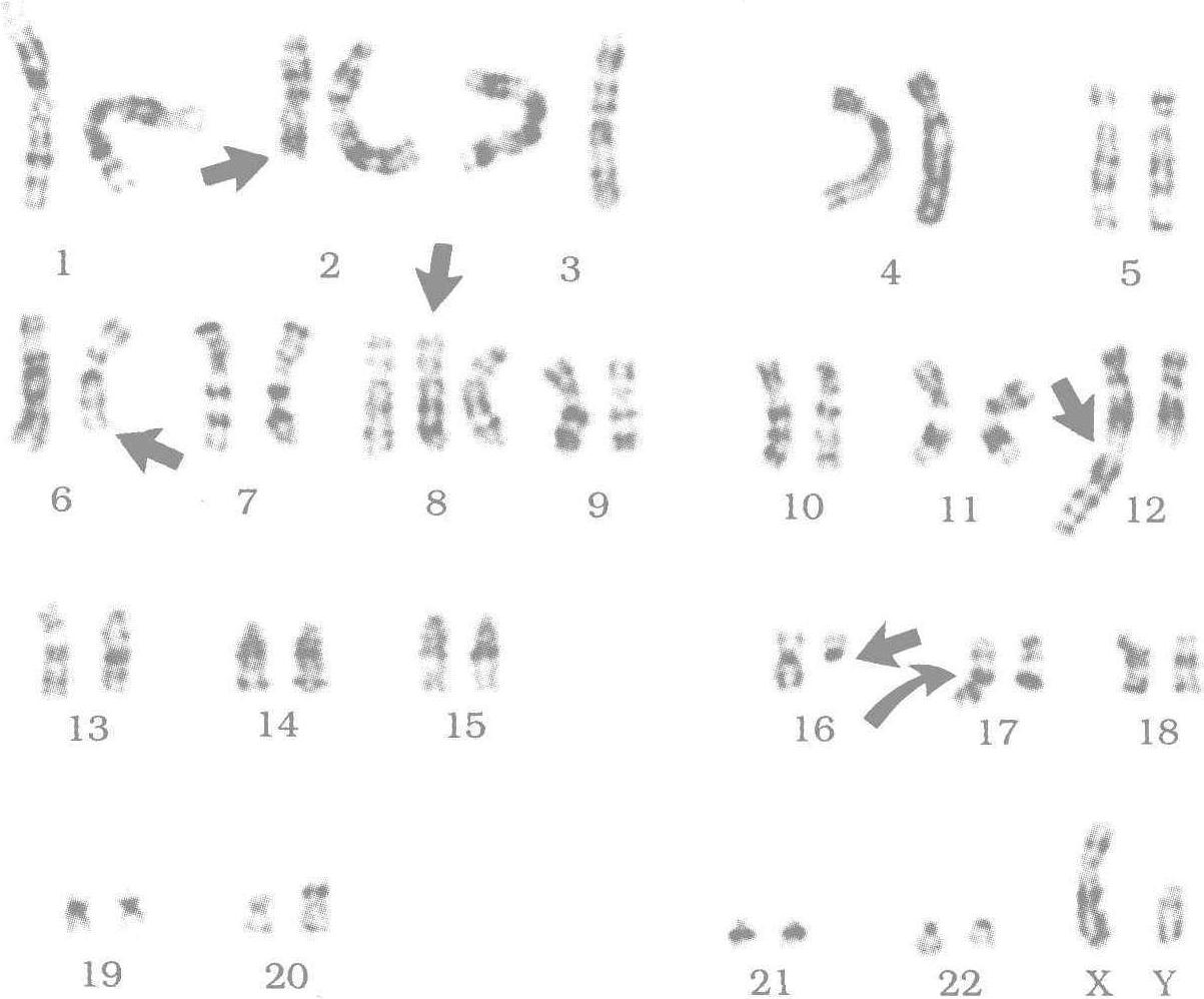 图81 图80的MDS(RA)患者转变为AML-M6时骨髓细胞G带核型-白血病细胞遗传学及-医学